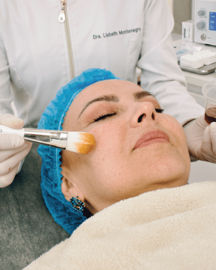 Peeling facial despigmentante - 5 sesiones