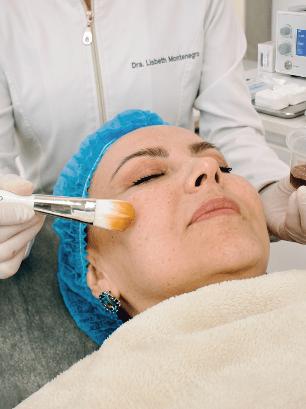 Peeling facial despigmentante - 5 sesiones