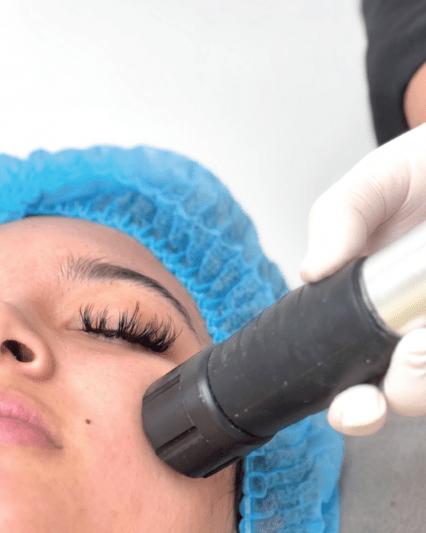 Ondas de choque facial - 3 sesiones