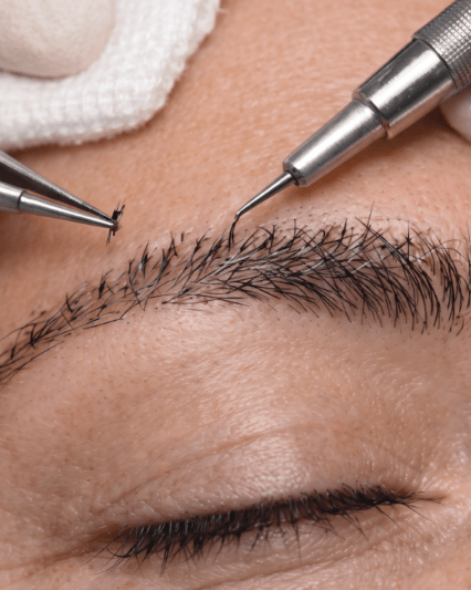 Trasplante de cejas