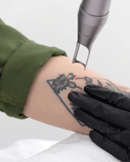 Remoción de tatuaje pequeño